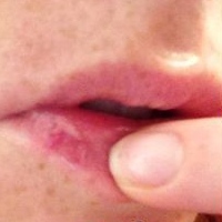 лечение герпеса на губах