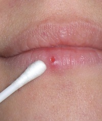 как лечить простуду на губе