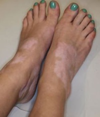 лечение витилиго куриной желчью